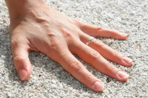 Диабет, псориаз или воспаление: на какие болезни может указывать состояние ногтей