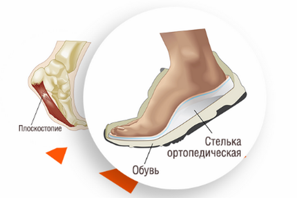Качественные ортопедические стельки – позаботьтесь о собственных ногах