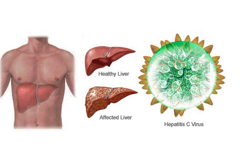 Гепатит С – симптомы и описание