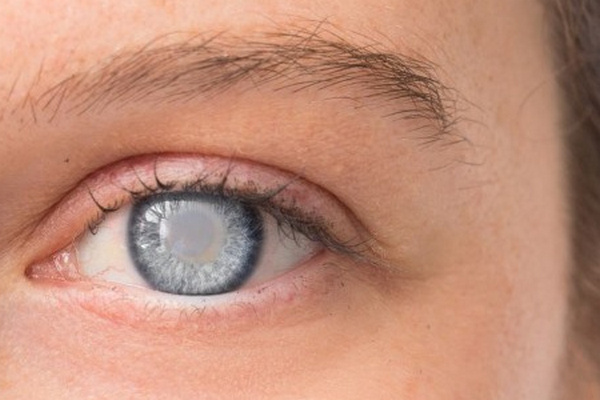 Уход за глазами и профилактика глаукомы
