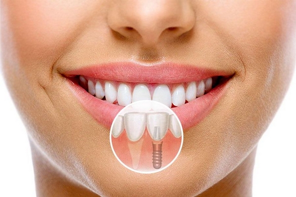 Имплантация передних зубов: что нужно знать