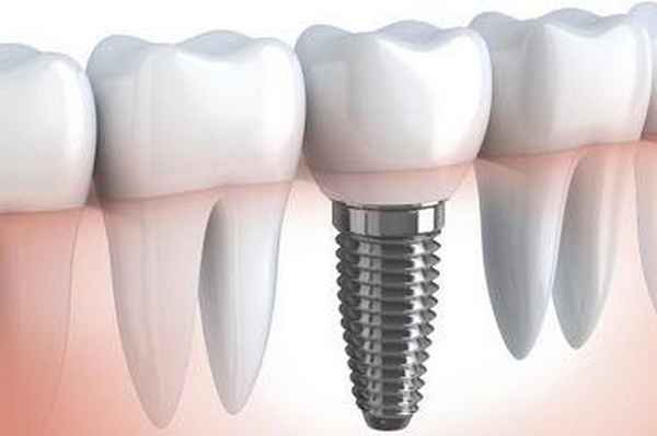 Как быстро и недорого восстановить утраченные зубы?