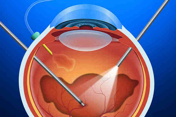 Операция при гемофтальме глаза