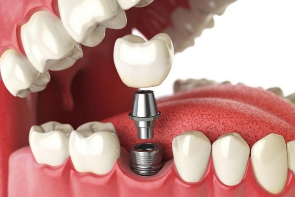 Що таке імплантація зубів і як проводять процедуру стоматологи