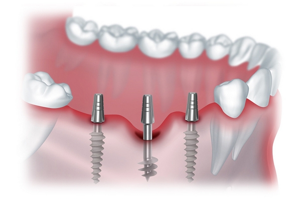 Що таке імплантація зубів і як проводять процедуру стоматологи