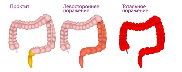 Что нужно знать о проктите