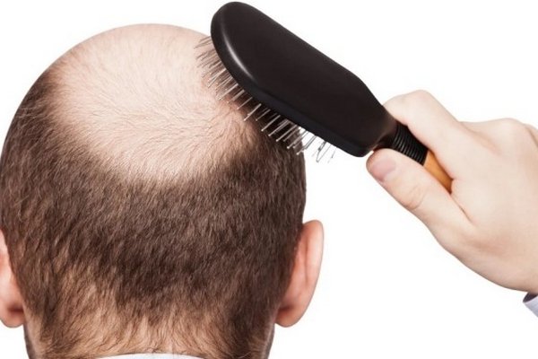 Появилось новое средство от облысения: волосы могут вырасти заново