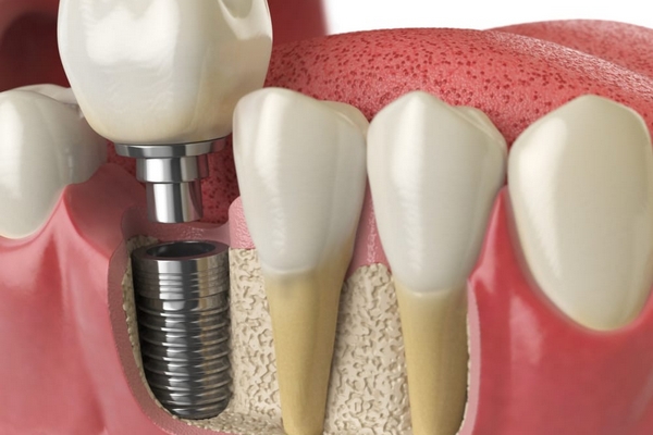 Синус-лифтинг в стоматологической практике