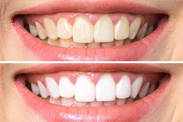 Стоматологи раскрыли секреты белой улыбки. Кофе и чай можно пить