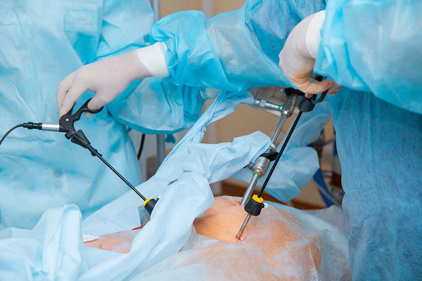 Операція варикоцеле – лікування лапароскопічним методом