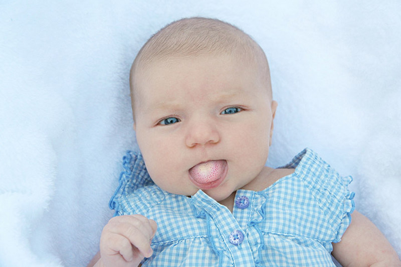 Появление молочницы во рту у новорожденных и его лечение.