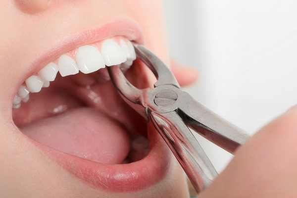 Стоматологические услуги. Нужно ли удалять зубы мудрости?