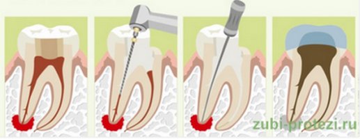 Болит зуб под протезом: как определить причину проблемы и что делать
