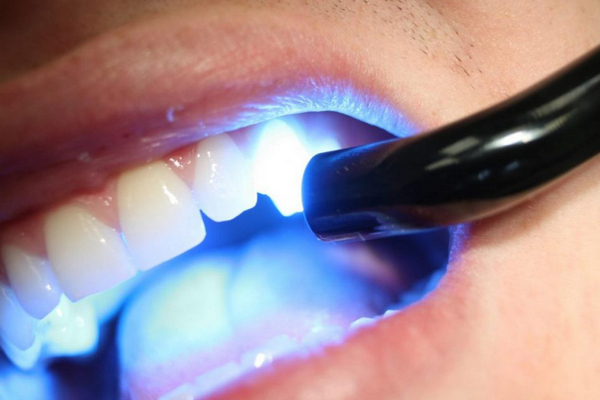 Особенности пломбирования передних зубов современными светоотверждаемы